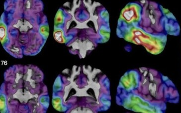 Una proteína natural del cerebro abre una nueva vía de investigación contra el Alzheimer