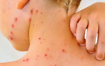 Sarampión: el viejo virus que regresa y pone en riesgo a los no vacunados